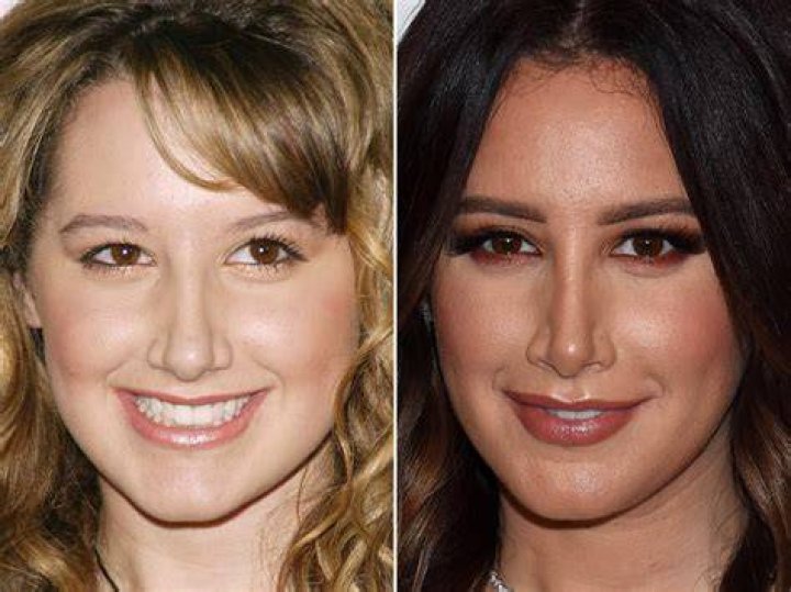 Ashley Tisdale Plastic Surgery Before and After