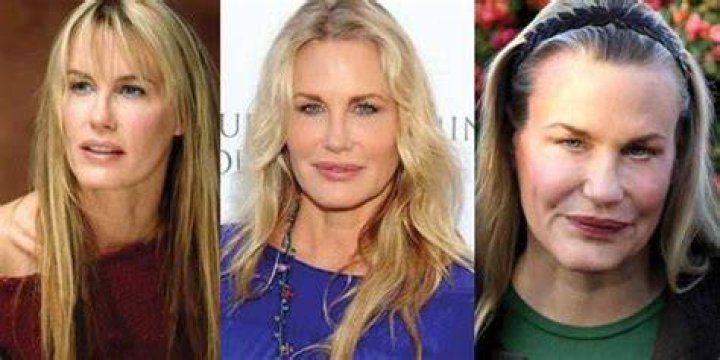 Daryl Hannah Plastic Surgery Before and After Botox Injections